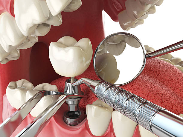 Best Chipped Tooth Repair Near Me  in San Leandro, CA